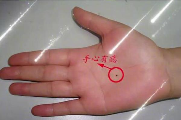 右手食指指尖痣相,右手食指和中指之间有痣 右手食指指尖痣相,右手食指和中指之间有痣