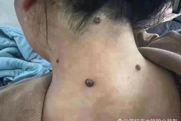 头后部痣相,头后面有痣代表什么