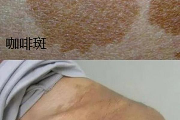 痣相印记 痣和胎记的区别图片