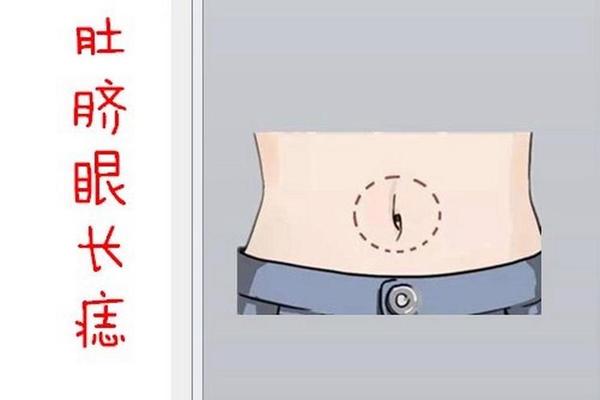 男人肚脐痣相—男人肚脐眼有痣代表什么