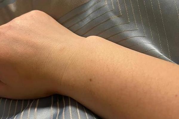 女相手腕有痣代表什么意思;女人手腕长痣好不好