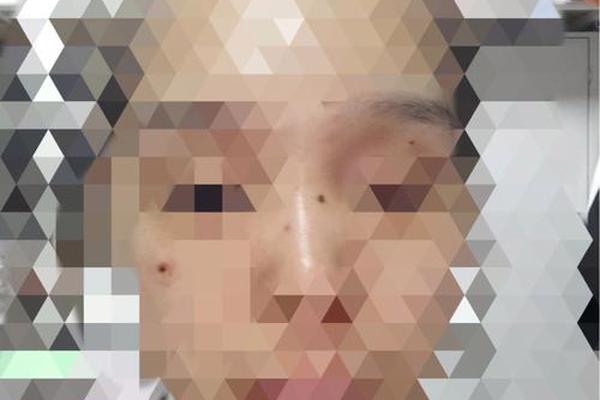相城哪里可以点痣—苏州点痣医院排名榜
