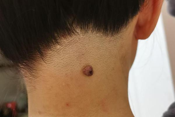 女人脖子后方偏右痣相解 脖子右后方有痣代表什么