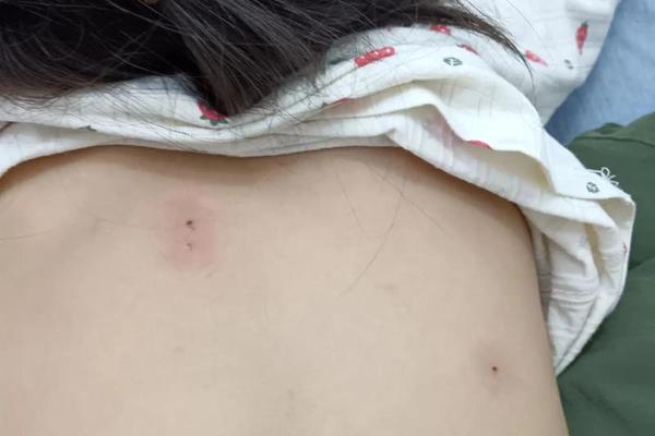 女背上痣相大全_后背痣相图解大全 女 女背上痣相大全_后背痣相图解大全 女