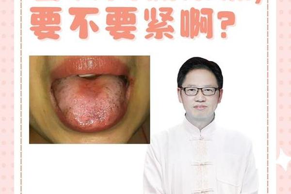 舌头长痣相;舌头长痣代表什么命运
