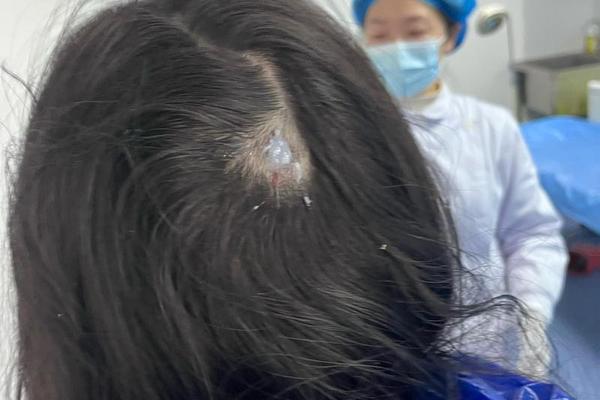 痣相头发里的痣_头发里长痣图片 痣相头发里的痣_头发里长痣图片