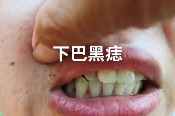 下巴底下藏着的暗痣痣相 女人下巴底正中间长痣 下巴底下藏着的暗痣痣相 女人下巴底正中间长痣