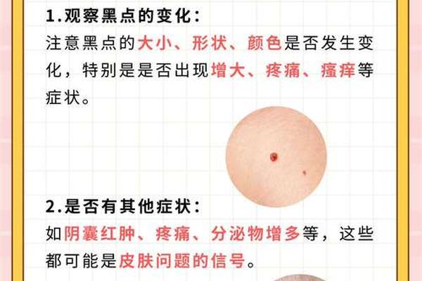 男人阴囊有痣相_男人身上痣相大全图解 男人阴囊有痣相_男人身上痣相大全图解