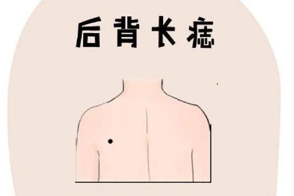 背上长痣相上好吗、后背长痣好不好