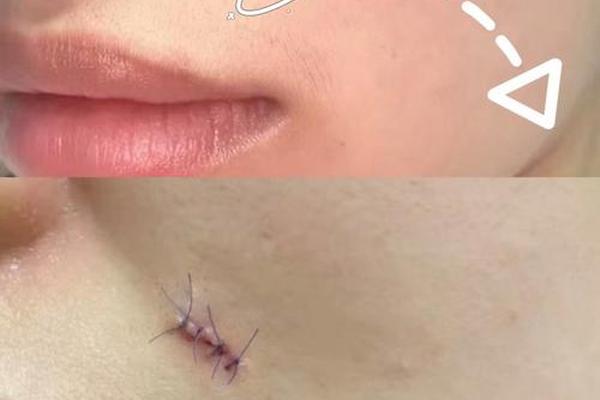 相数之一的痣叫什么痣(手术切痣按个数收费)