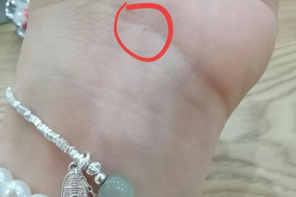 痣相手腕痣—手腕上长了一个痣
