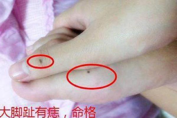 右脚趾缝痣相、女人右脚二脚趾有痣代表什么