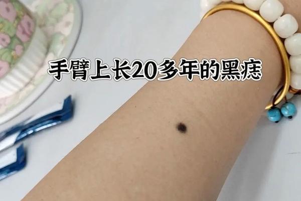 痣相女手臂部痣相图解、女生胳膊上长痣图解 痣相女手臂部痣相图解、女生胳膊上长痣图解