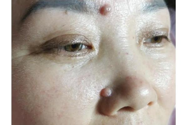 相双眼皮上长了一颗肉痣、额头长肉痣好不好