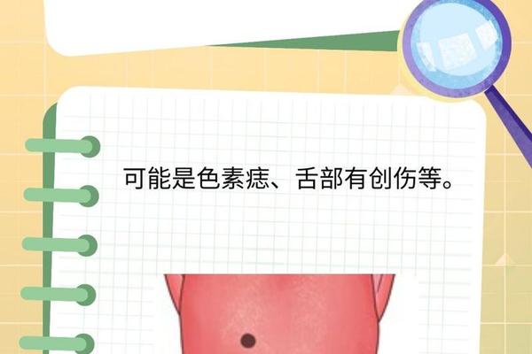 舌头 痣 相,舌头长痣代表什么命运 舌头 痣 相,舌头长痣代表什么命运
