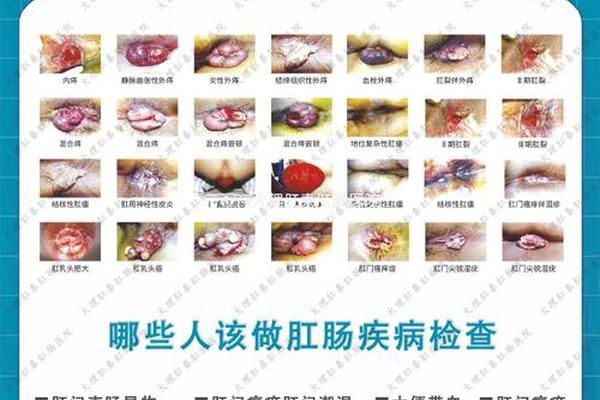 屁股屎相有痣看相图解—苍蝇拉的屎会变成痣吗