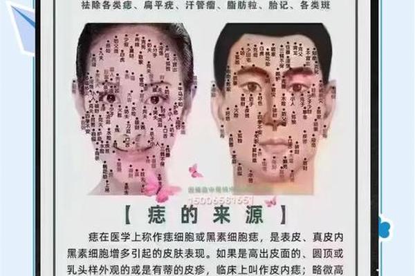 常鹤鸣说痣相—中医认为长痣体质的原因 常鹤鸣说痣相—中医认为长痣体质的原因