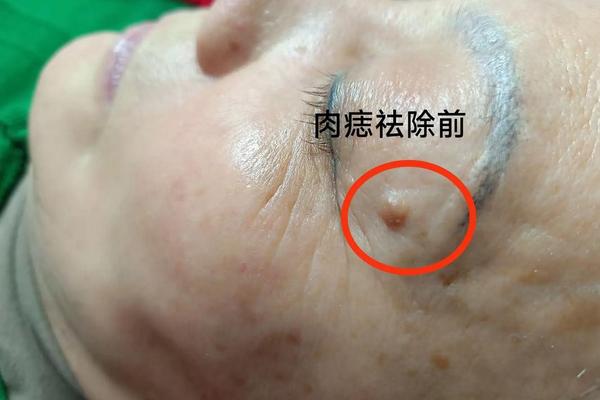肉痣体相,肉痣的各种形状图片