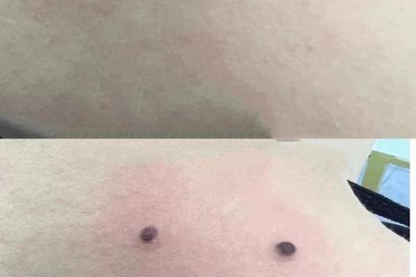 背后生痣相—后背有痣命苦