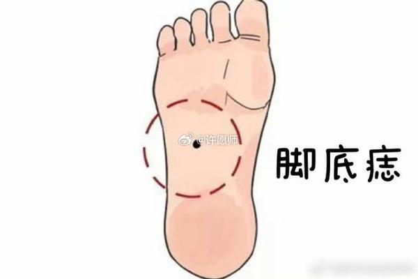 无名脚趾头有痣相 脚无名指有痣代表什么