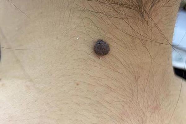 痣相真实案例—痣良性和恶性区别图片对比