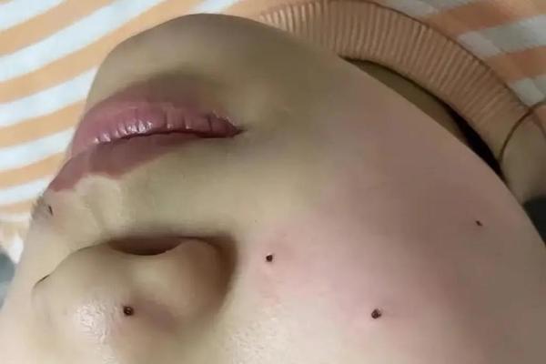 一大一小相邻的痣_两颗小痣挨得很近