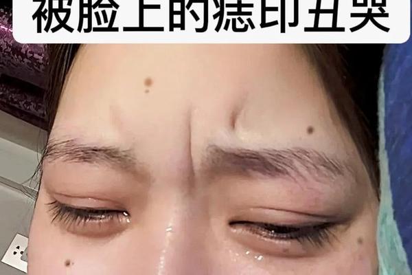 点了痣就是破了相吗、痣破了能点吗 点了痣就是破了相吗、痣破了能点吗