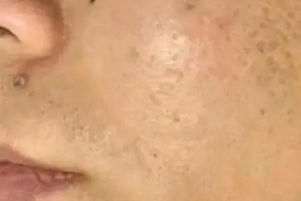 看男相祛痣图片大全集视频—祛痣图片对比照片高清 看男相祛痣图片大全集视频—祛痣图片对比照片高清