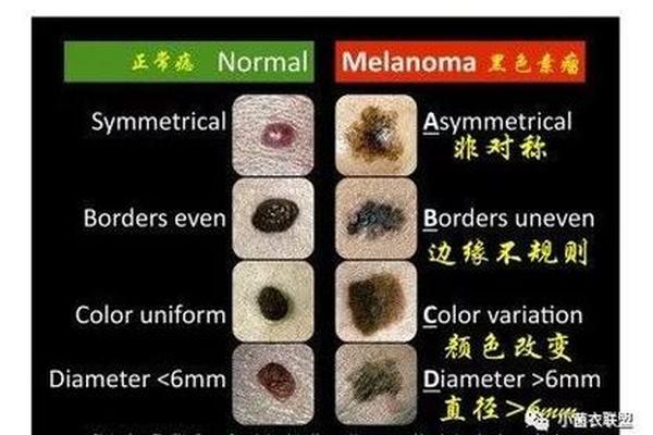 痣相大富是黑色(最有出息的痣相) 痣相大富是黑色(最有出息的痣相)