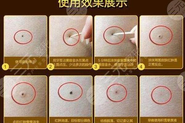 美相设计点痣、药水点痣图