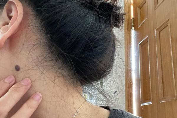 脖子上不同的痣相_脖子上长了好几个痣