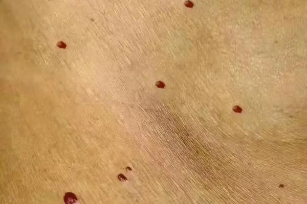 红痣是吉相吗 红痣代表什么命运 红痣是吉相吗 红痣代表什么命运