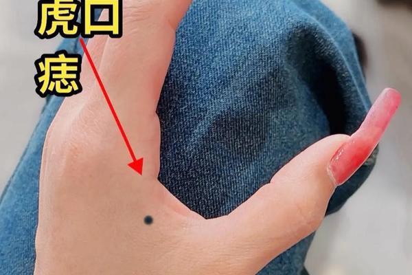 女人左手背痣相最准图—左手长痣说明什么