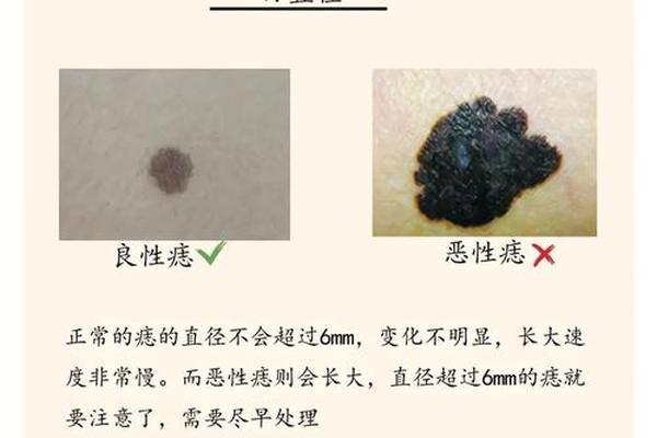 痣相痣变颜色 痣变颜色了是什么原因