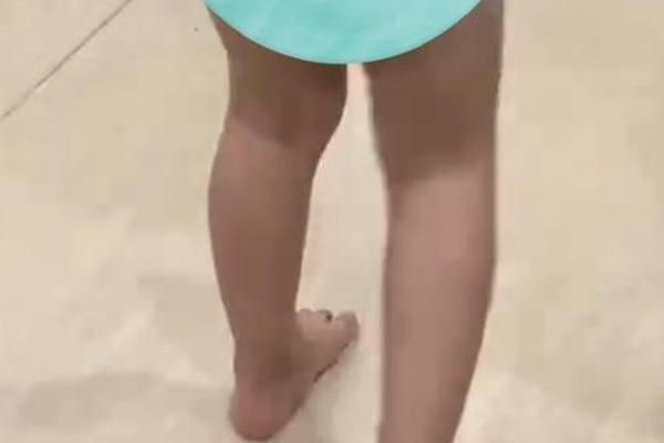 孩子内八字 孩子内八字
