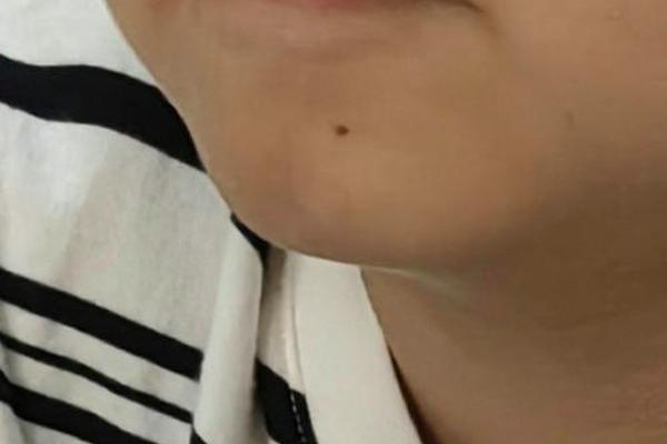 女痣相嘴角-嘴角长痣的男人面相