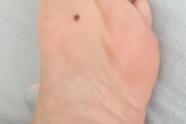 女人脚底痣相全解 脚底有痣的女人命运