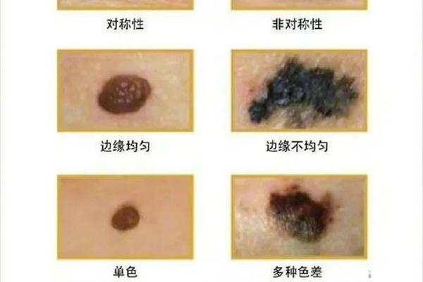 痣相印记 痣和胎记的区别图片