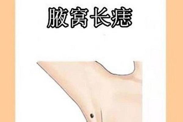 腋窝旁边的痣相-腋窝附近的痣代表什么