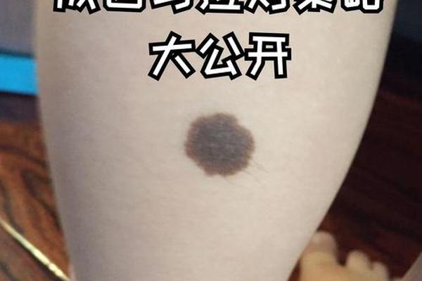 长毛的痣痣相-痣上面长毛是什么痣