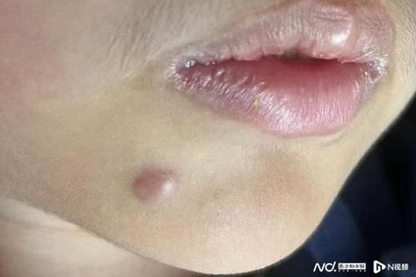 观相女人被点痣视频(点痣的全过程视频)