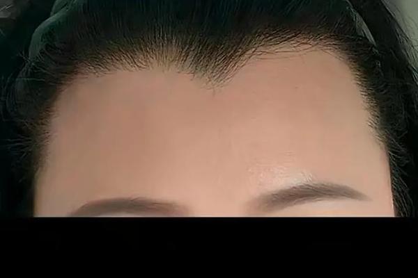 美人尖痣相,一般什么人会有美人尖