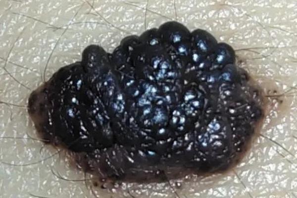 痣相大富是黑色(最有出息的痣相) 痣相大富是黑色(最有出息的痣相)