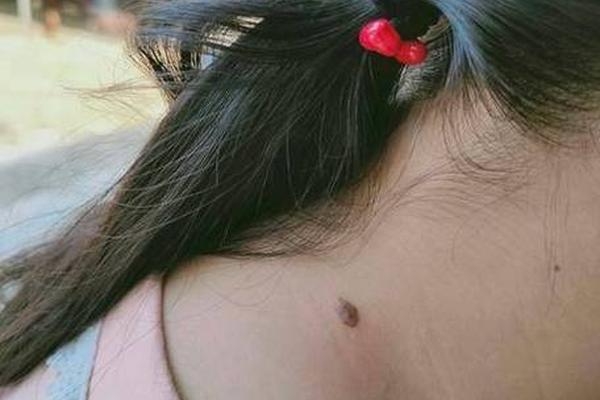 腋窝痣相深山老林,离右腋窝一寸处有痣图片