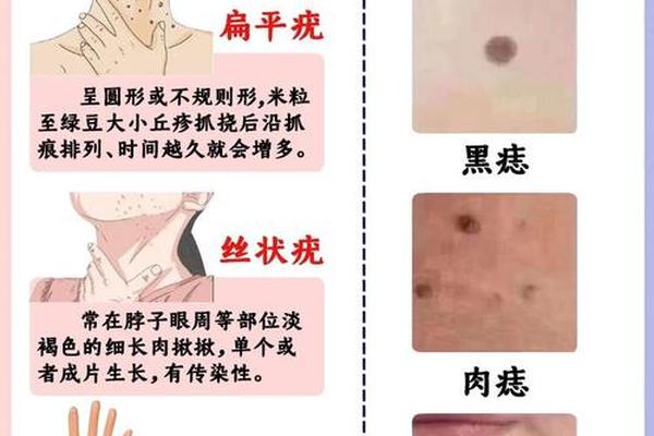道具小痣相(相学上瘊子和痣的区别)