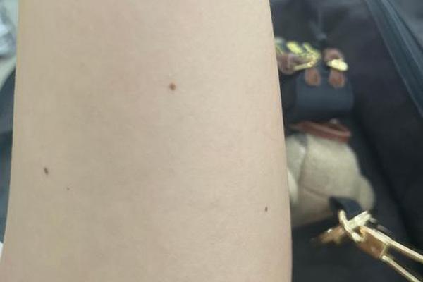 观相三颗痣出自哪本书 三颗痣连起来是三角形