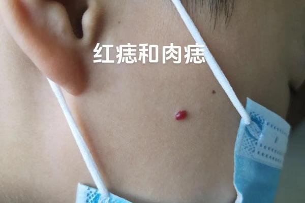 肩膀上长红痣痣相(肩膀上有颗红痣的人,命是不是很好)