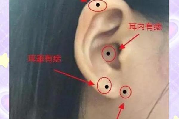 痣相耳部、耳朵长痣的位置代表什么 痣相耳部、耳朵长痣的位置代表什么