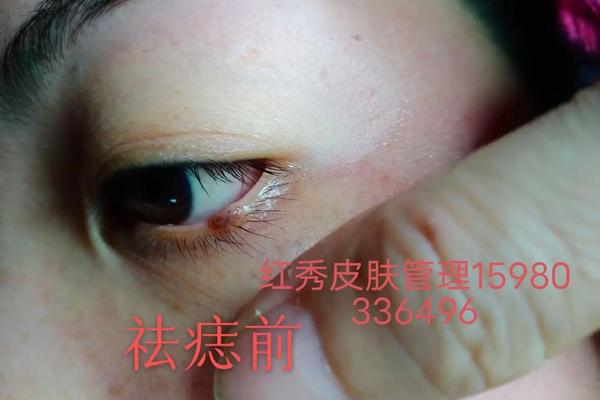 男人流泪痣相、男人脸上的流泪痣什么意思 男人流泪痣相、男人脸上的流泪痣什么意思