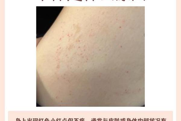相 红痣-红痣代表什么命运